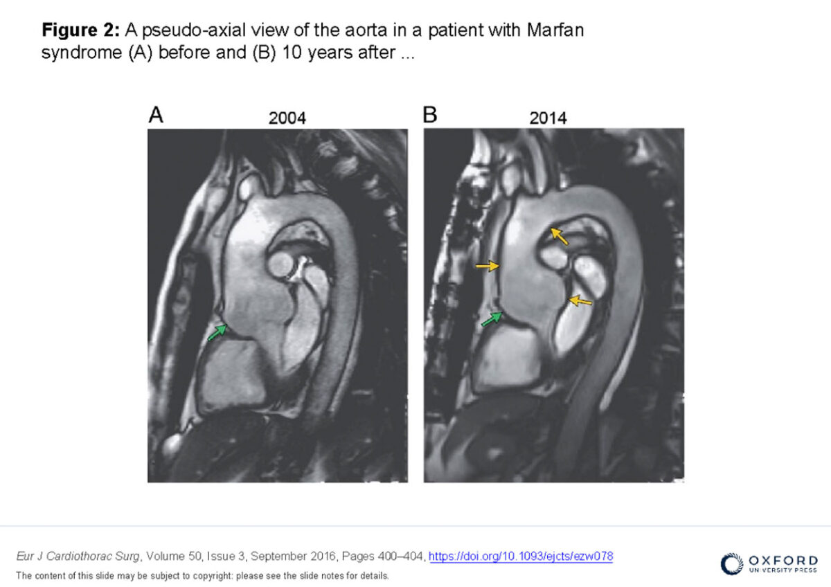 The PEARS procedure The Cardiac Centre